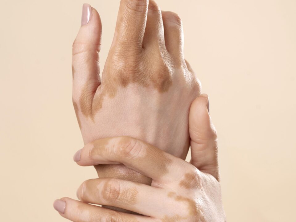 Dermatologist explaining vitiligo treatment options in Mira Road Mumbai