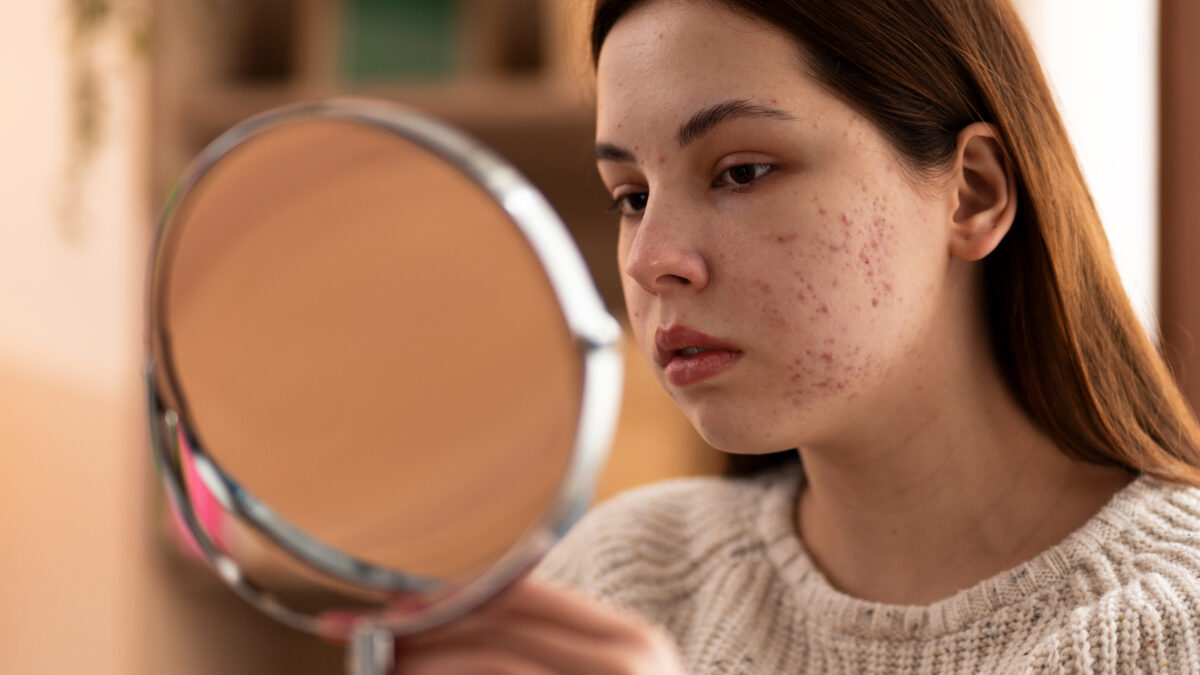 Gentle skincare routine to help prevent hormonal acne during periods