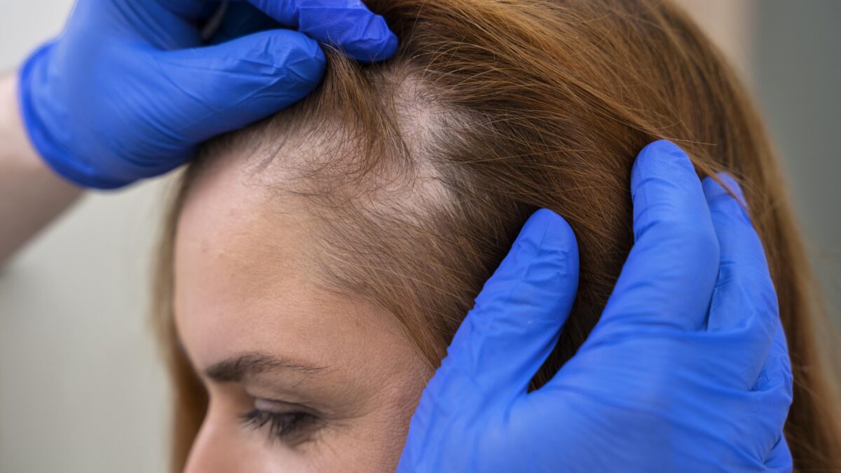 Dermatologist examining the scalp to diagnose hair loss and recommend treatment in Mira Road