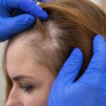 Dermatologist examining the scalp to diagnose hair loss and recommend treatment in Mira Road