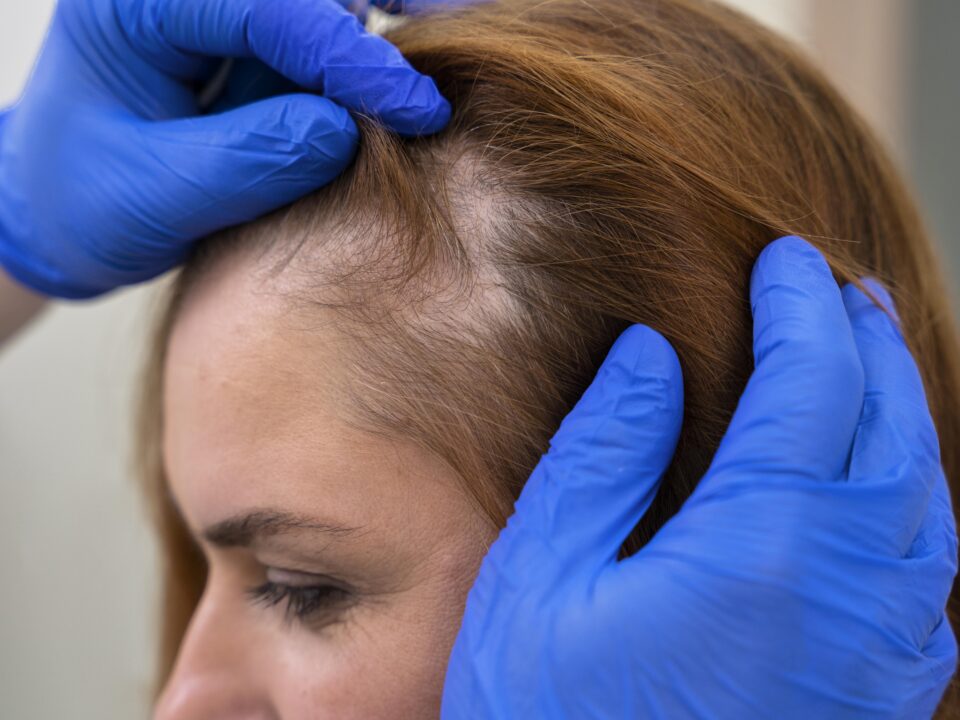 Dermatologist examining the scalp to diagnose hair loss and recommend treatment in Mira Road